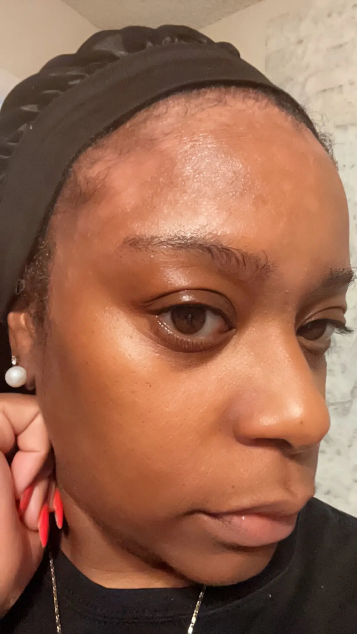 Before and after seborrheic dermatitis treatment, seb derm nose, severe psoriasis