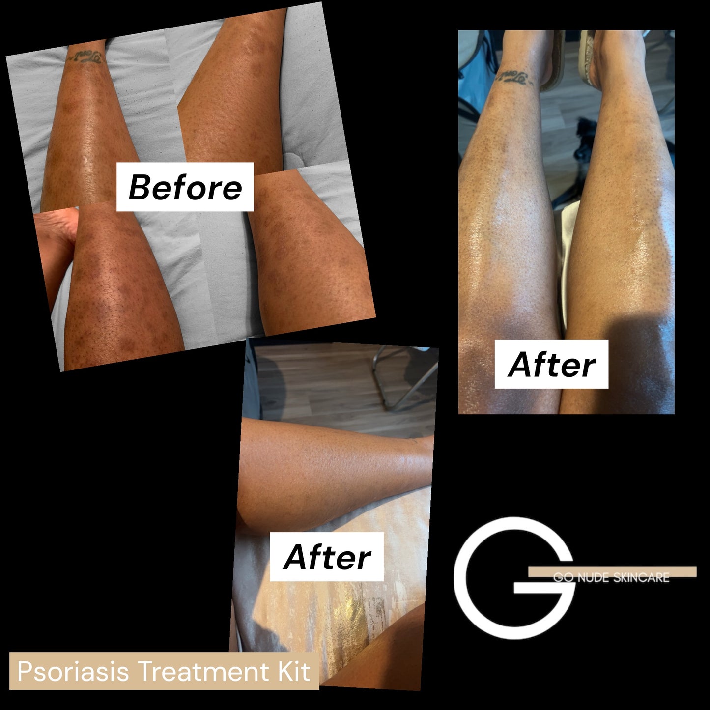 Psoriasis and Eczema Relief Collection | Natural Skincare for Sensitive Skin