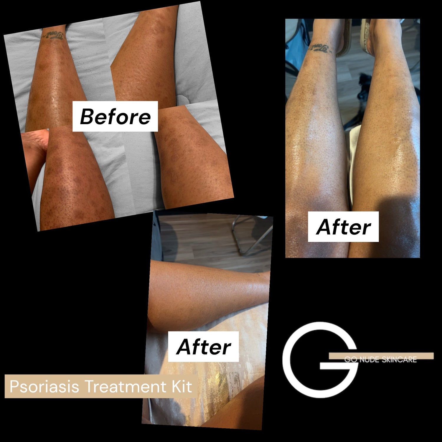 Psoriasis Treatment Kit™ – Relief for Plaque Psoriasis & Itchy Skin