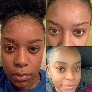 Before and after seborrheic dermatitis treatment, seb derm nose, severe psoriasis, plaque psoriasis, scalp psoriasis
seborrheic dermatitis cleanser

natural seborrheic dermatitis treatment

face cleanser for eczema

dry flaky skin relief

forehead and nose dermatitis cleanser

gentle skin cleanser for dermatitis

scalp and facial psoriasis cleanser

all-natural seborrheic cleanser

sensitive skin dermatitis solution

itch and redness relief cleanser