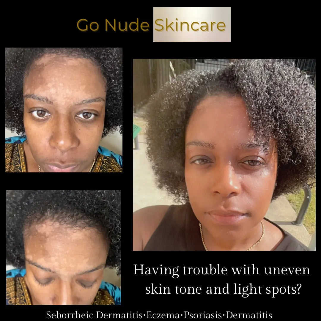 Scale Away Cleanser Go Nude Skincare
seborrheic dermatitis cleanser

natural seborrheic dermatitis treatment

face cleanser for eczema

dry flaky skin relief

forehead and nose dermatitis cleanser

gentle skin cleanser for dermatitis

scalp and facial psoriasis cleanser

all-natural seborrheic cleanser

sensitive skin dermatitis solution

itch and redness relief cleanser