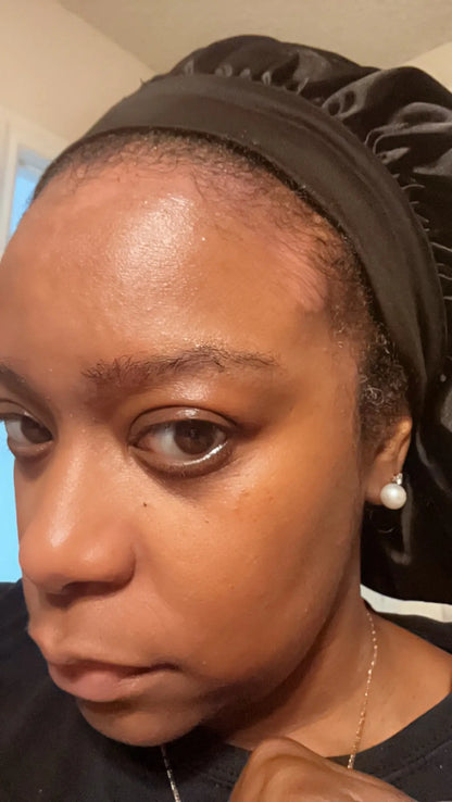 Before and after seborrheic dermatitis treatment, seb derm nose, severe psoriasis