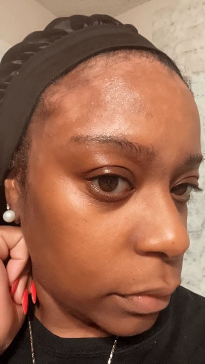 Before and after seborrheic dermatitis treatment, seb derm nose, severe psoriasis, plaque psoriasis, scalp psoriasis