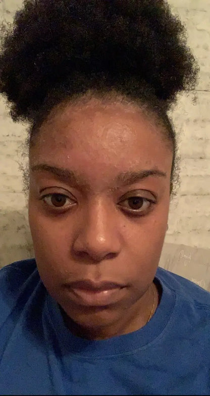 Before and after seborrheic dermatitis treatment, seb derm nose, severe psoriasis