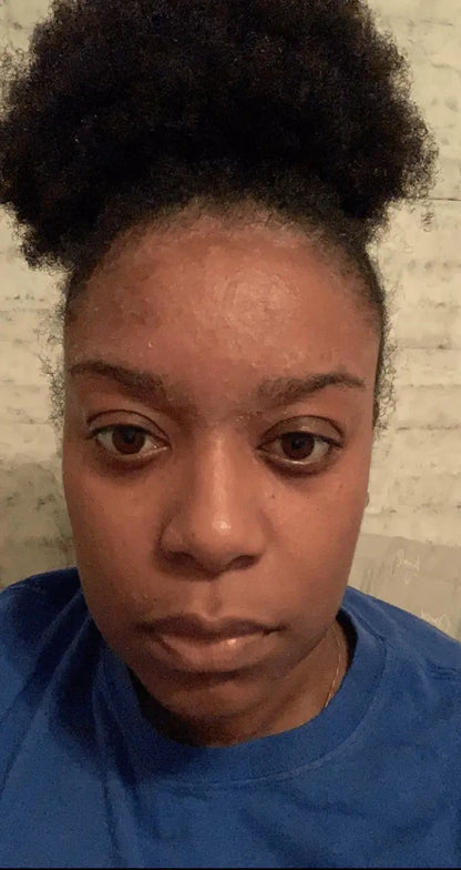 Before and after seborrheic dermatitis treatment, seb derm nose, severe psoriasis, plaque psoriasis, scalp psoriasis