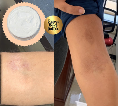 Eczema Relief Butter | Natural Hydration for Sensitive Skin